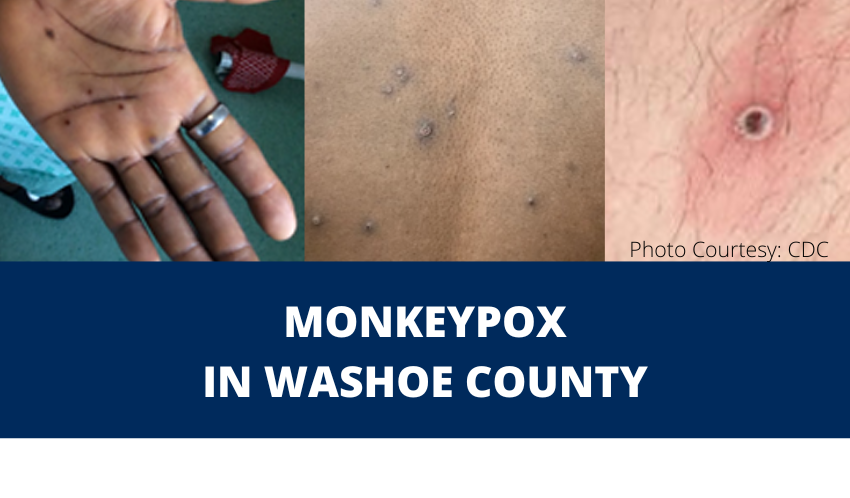 4th monkeypox case confirmed in Washoe County